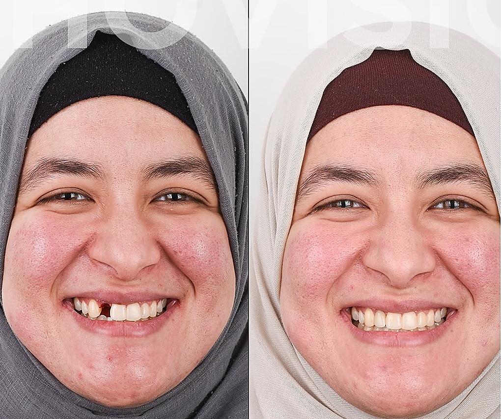 Sourire patient OrthoVision